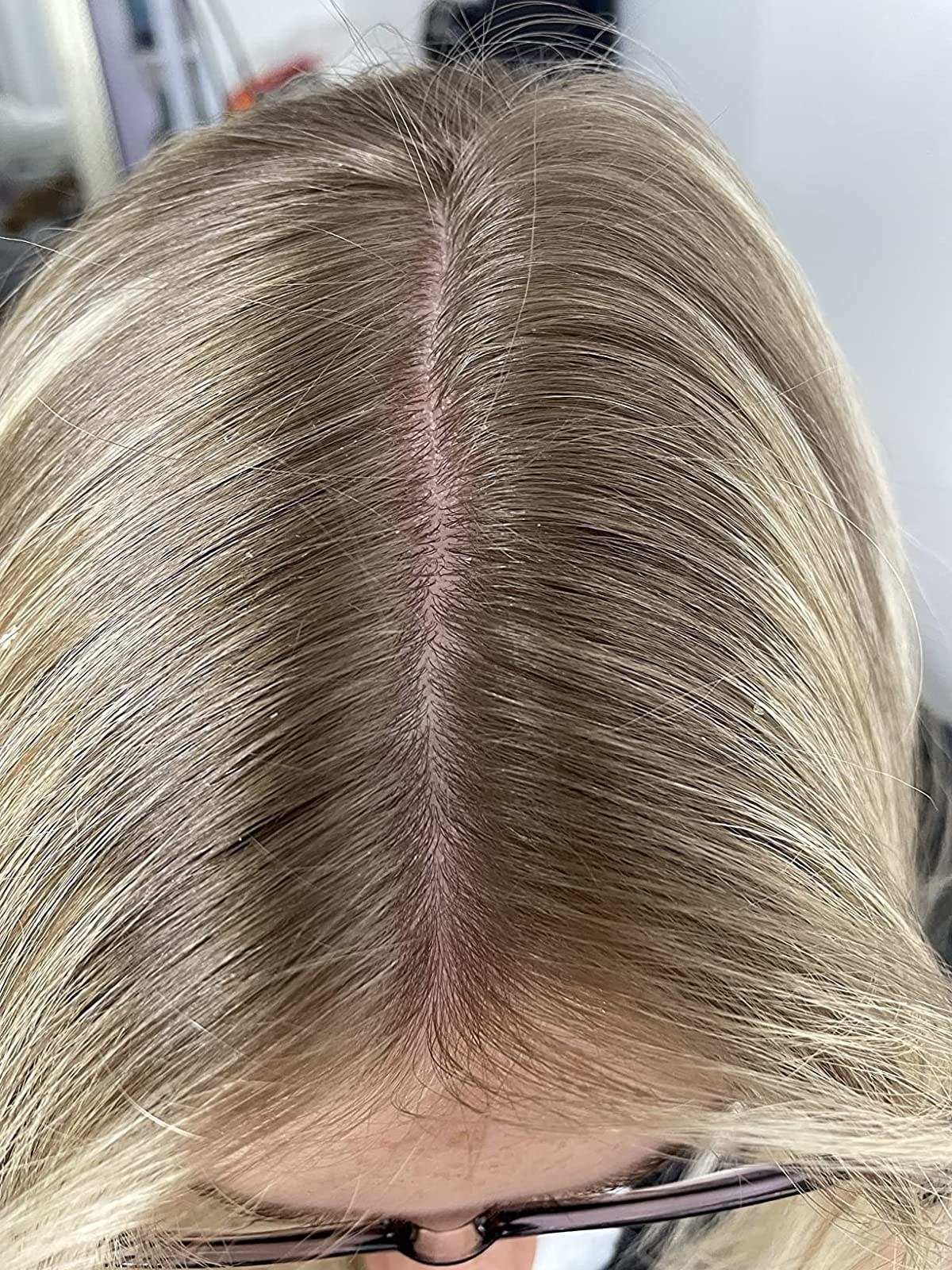 Reviewer showing their scalp after using the anti-dandruff shampoo