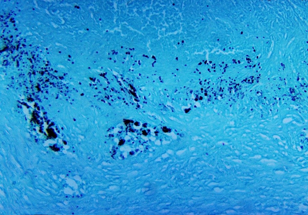 This micrograph depicts the histopathologic changes associated with cryptococcosis of the lung using GMS stain, 1964