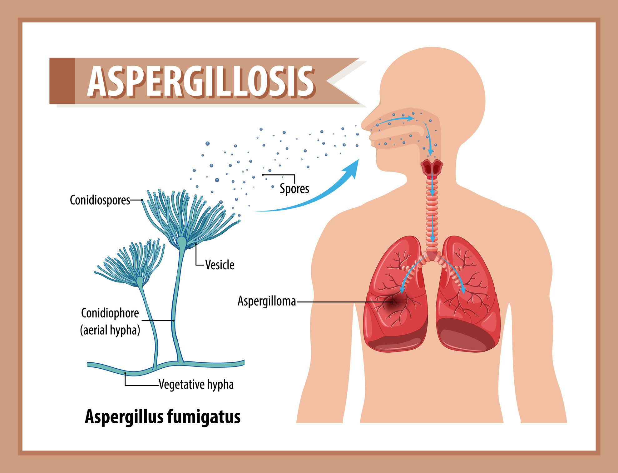 Diagram showing aspergillus infection illustration