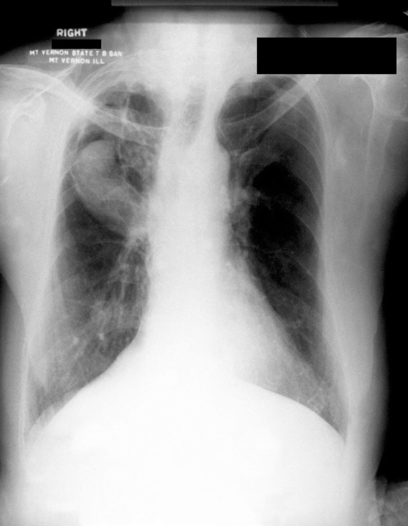Chest radiograph showing Aspergillosis (fungus ball) in the upper lobe of the right lung