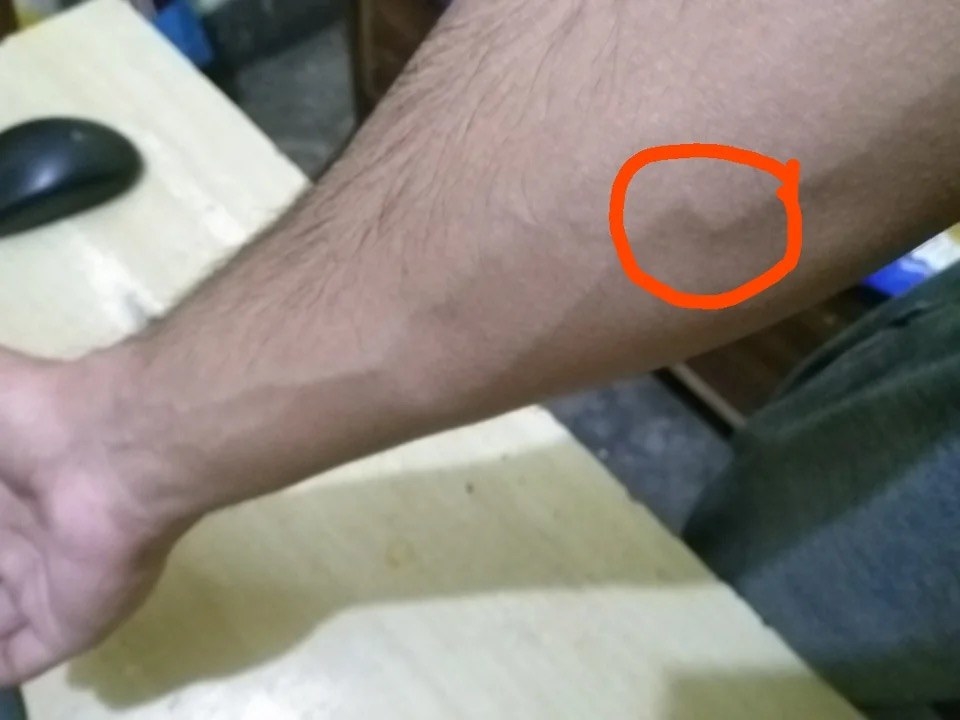 A man&#x27;s arm with a circle around part of his arm vein that is at a 90 degree angle