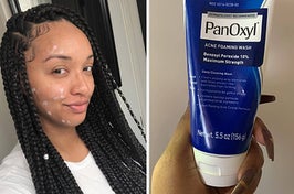 Reviewer's Mario Badesco acne spot treatment applied on their face and a reviewer holding their PanOxyl acne foaming wash