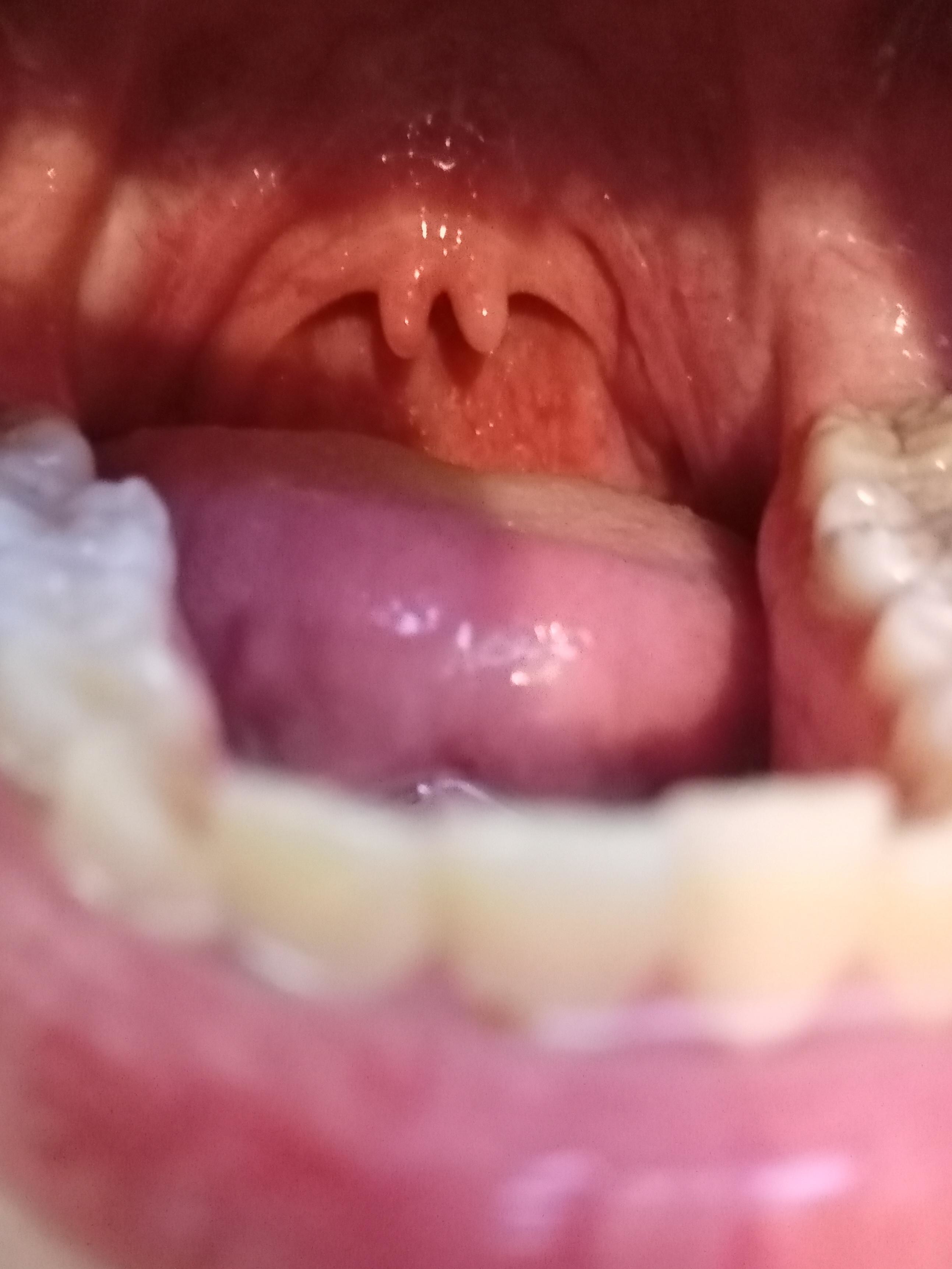 A uvula with two descending parts