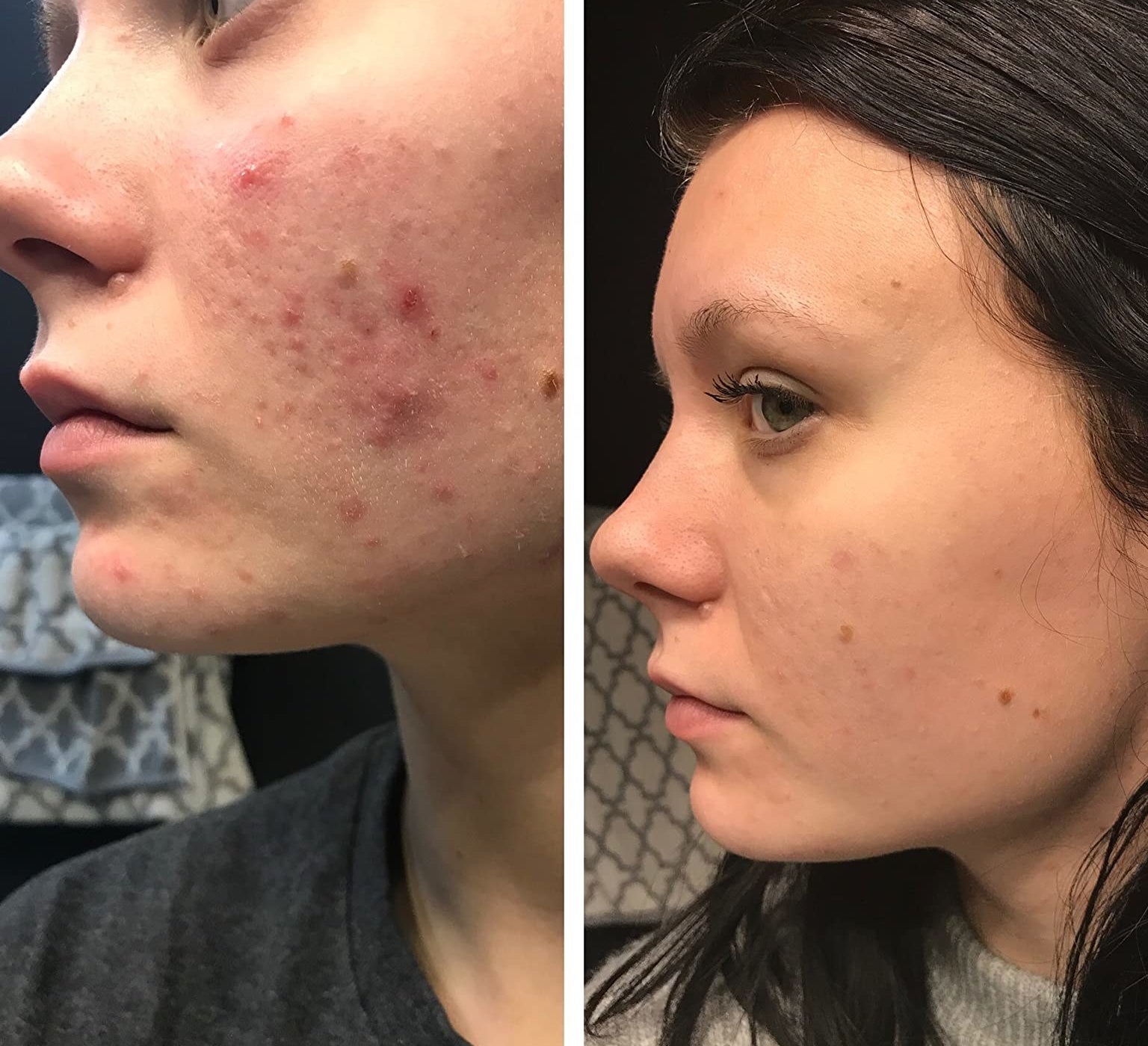 on the left, a reviewer with acne on their cheeks and, on the right, the same reviewer with their acnes largely cleared