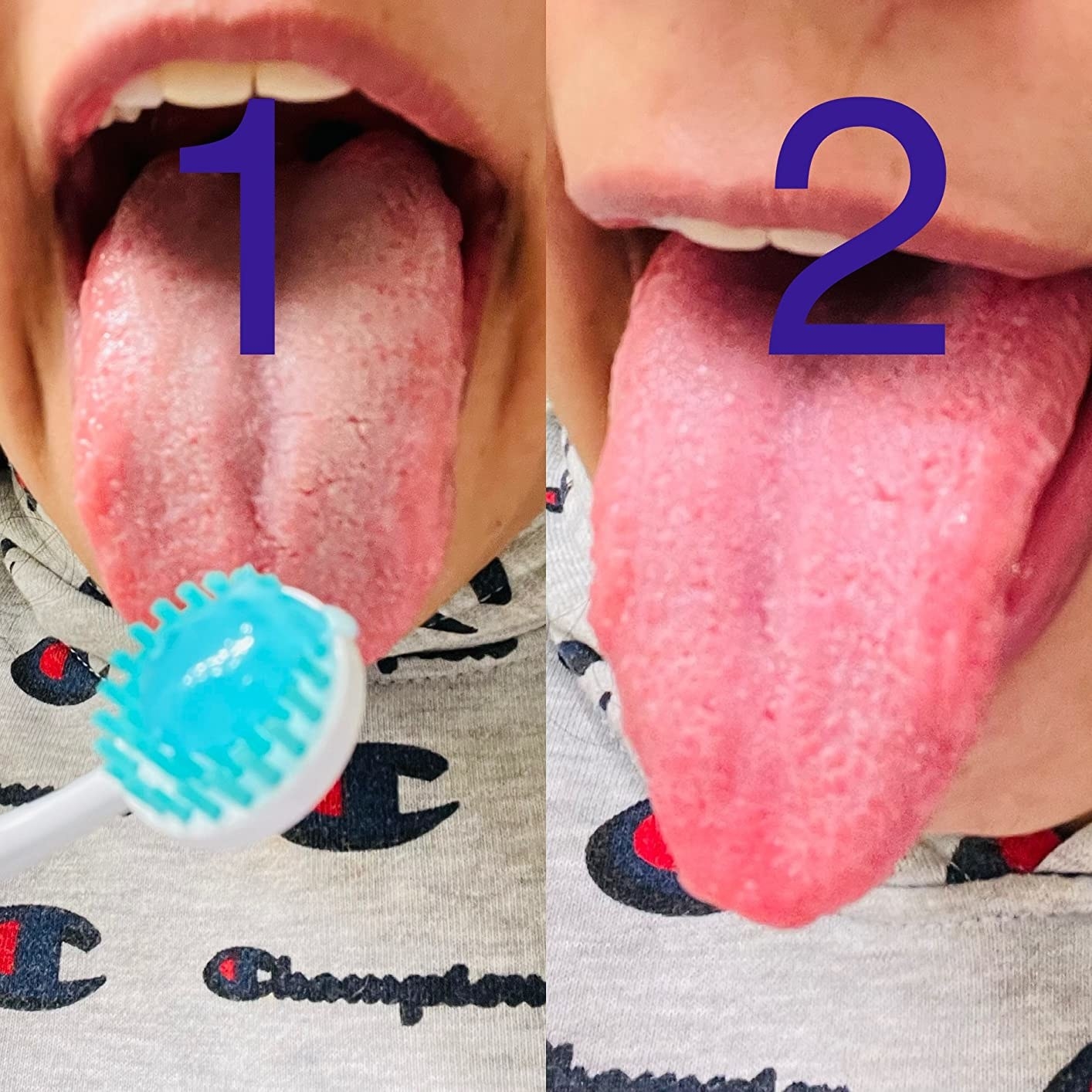 Reviewer&#x27;s photos before and after using the tongue brush