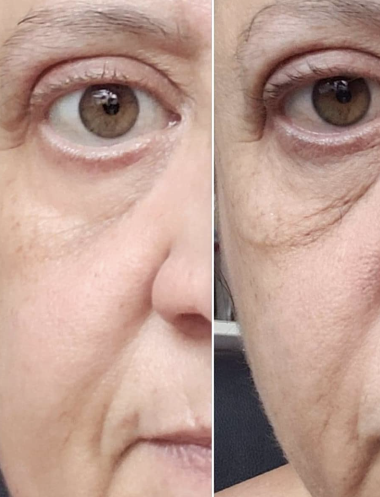 Reviewer before and after showing the cream tightened and brightened their under-eye area