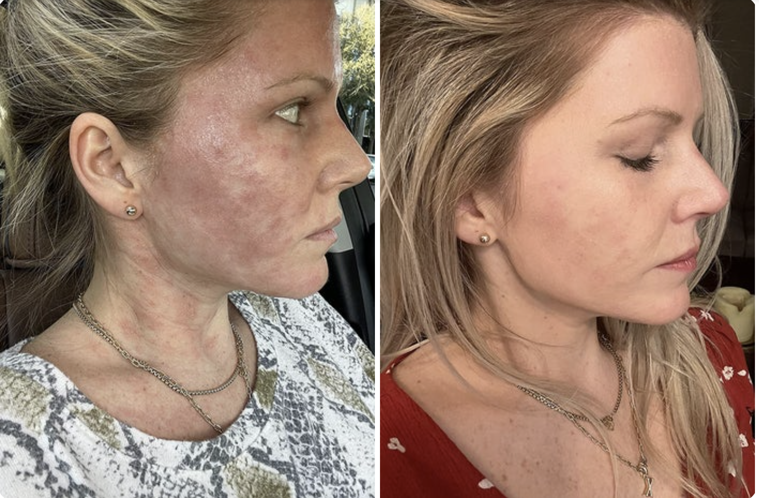 A reviewer&#x27;s skin before with redness and irritation, and after with almost none