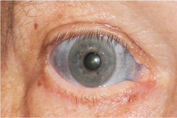 A Man's Eyes Were Stained Blue After He Took An Antibiotic To Treat  Inflammation