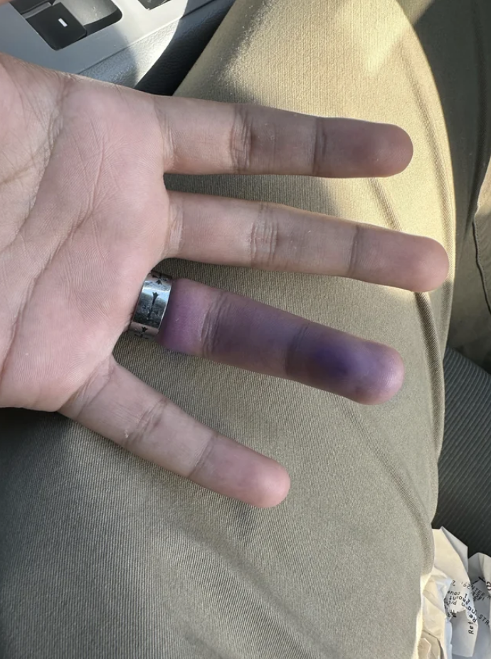 A ring stuck on someone&#x27;s purple finger