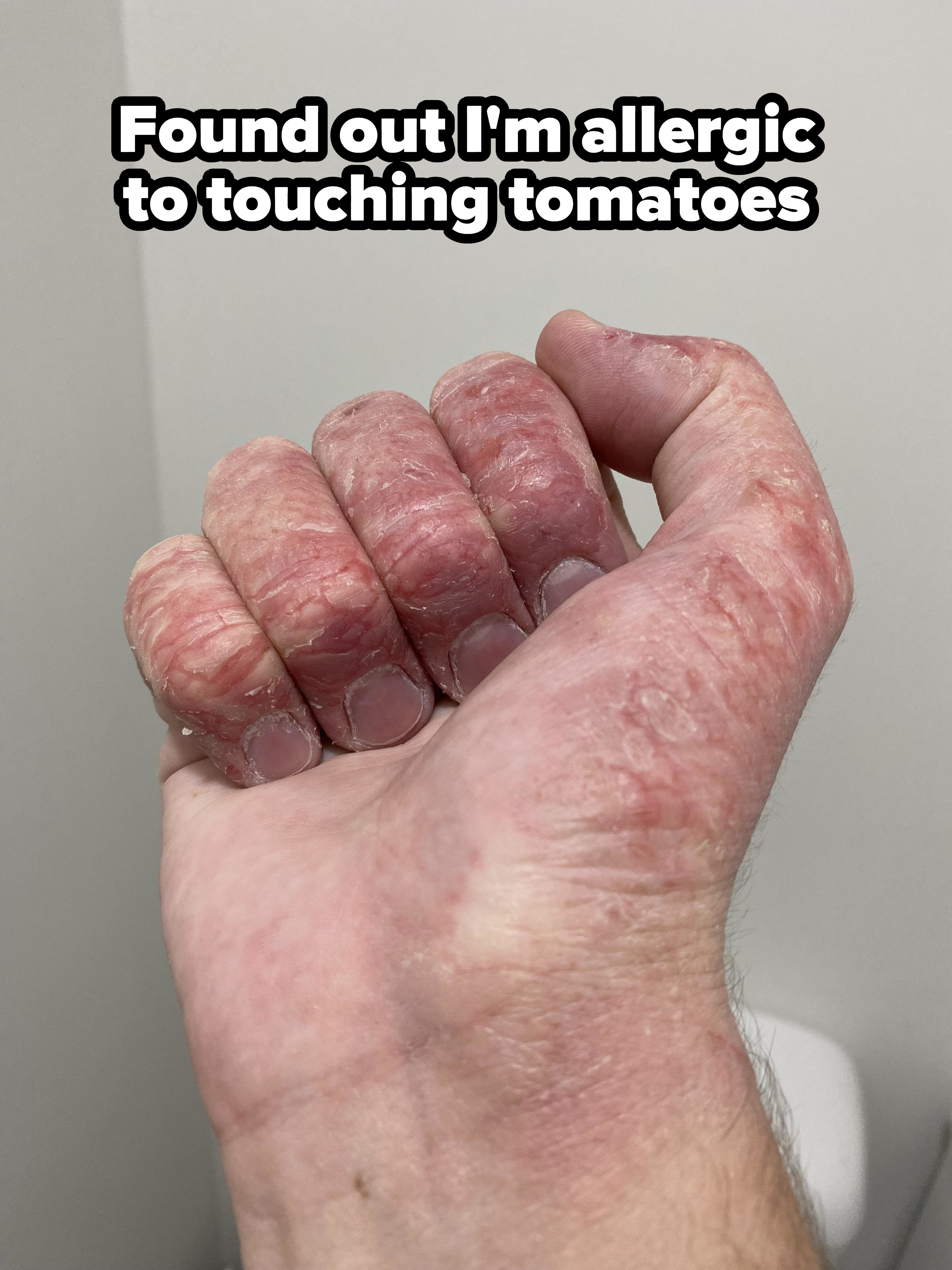 hand with many rashes on it