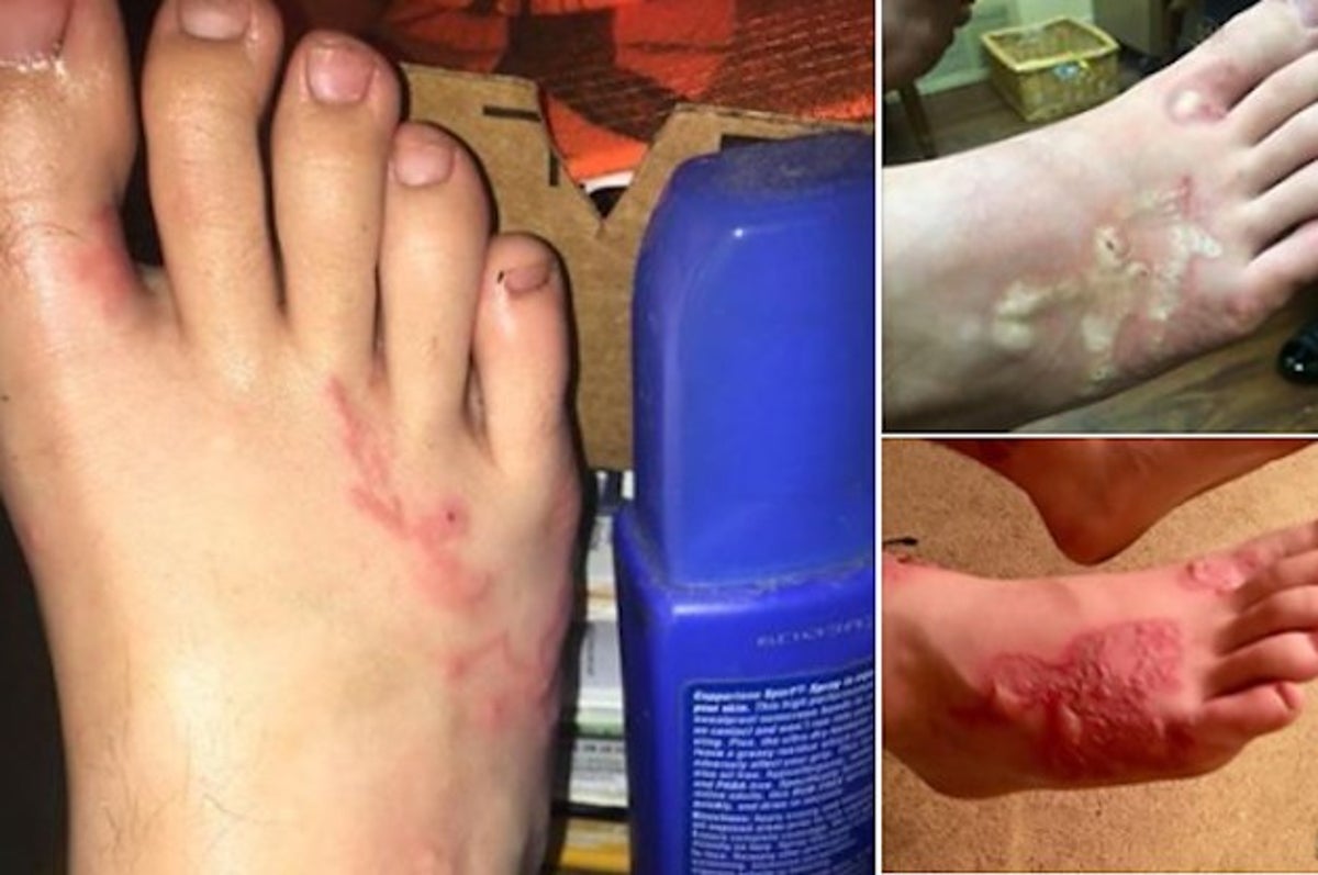 This Teen Got Hookworms After His Friends Buried Him In The Sand At The  Beach