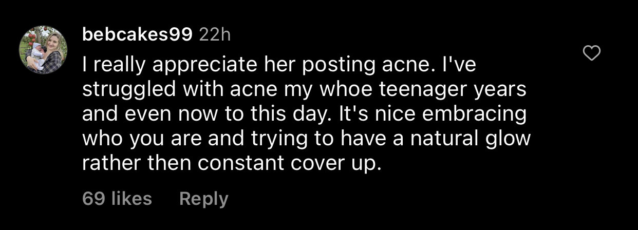 &quot;I really appreciate her posting acne; I&#x27;ve struggled with acne my whole teenager years and even now to this day; it&#x27;s nice embracing who you are and trying to have a natural glow rather [than] constant cover up&quot;