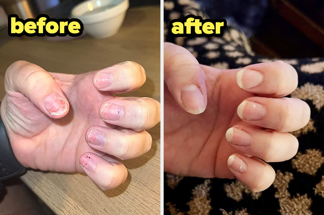 before and after of reviewer&#x27;s nails, showing them looking rough and brittle before using the nail oil, and an after photo of them looking long and strong a few months later