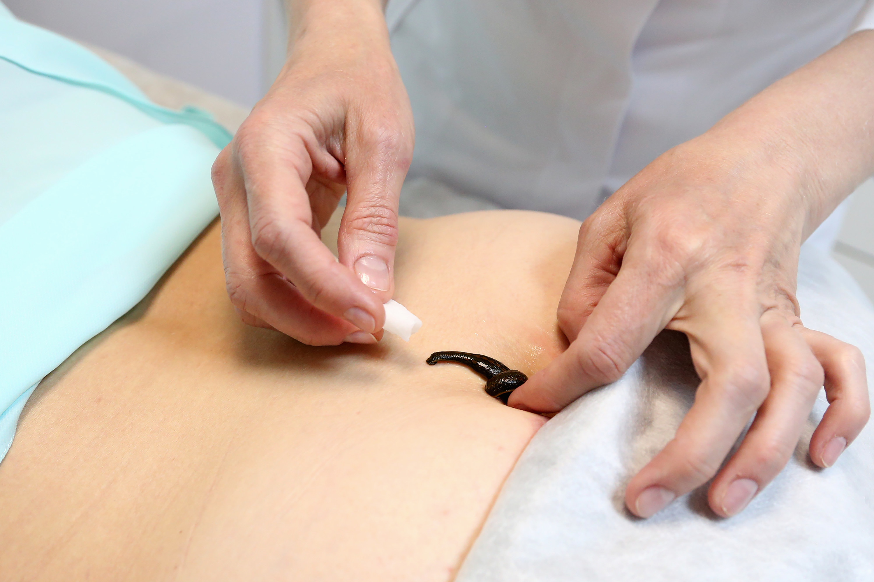 An image of a leech being placed on a woman&#x27;s belly by a medical professional