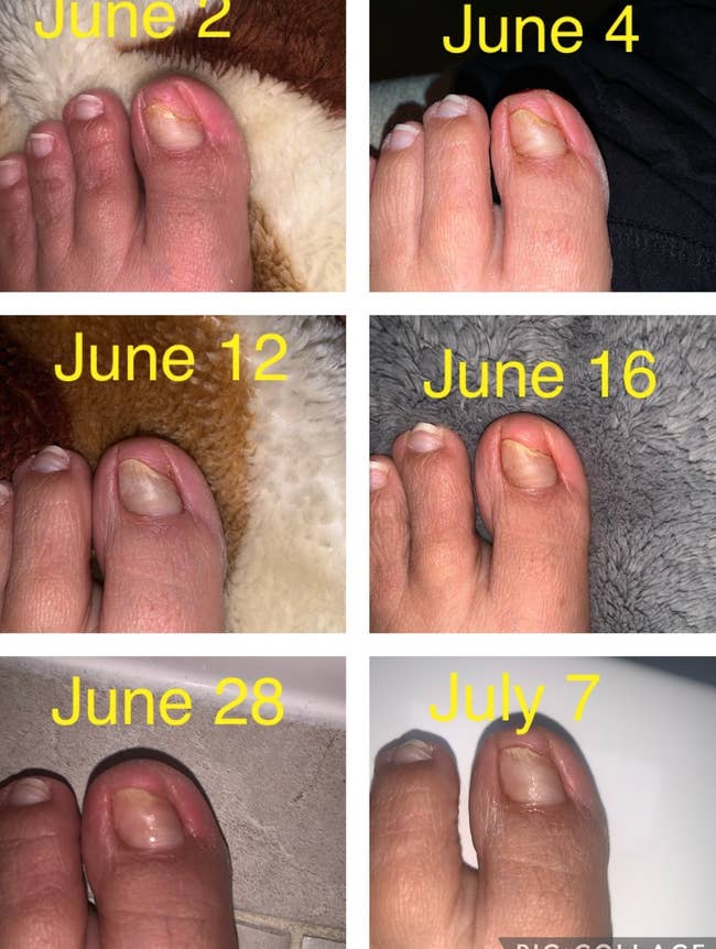 Before and after of reviewer's toenail showing the pen got rid of their toenail fungus