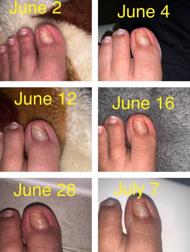 Before and after of reviewer's toenail showing the pen got rid of their toenail fungus