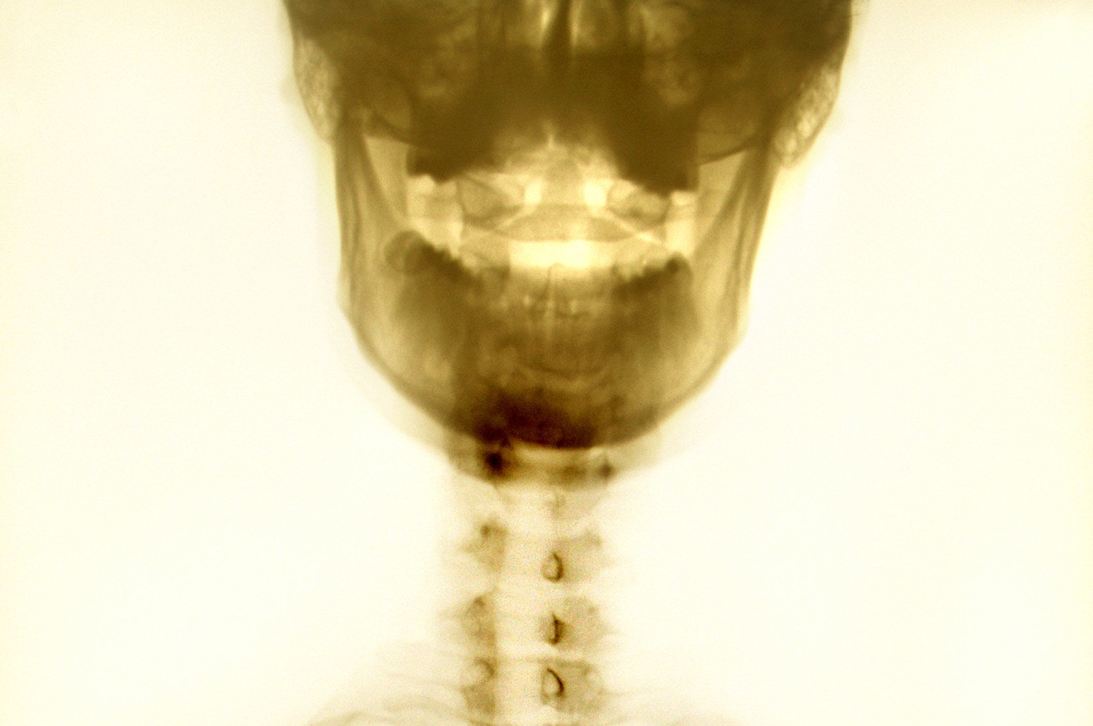 skeletal x-ray of a chin and jaw