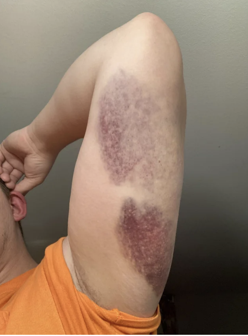 Large purple bruises on a person&#x27;s raised underarm