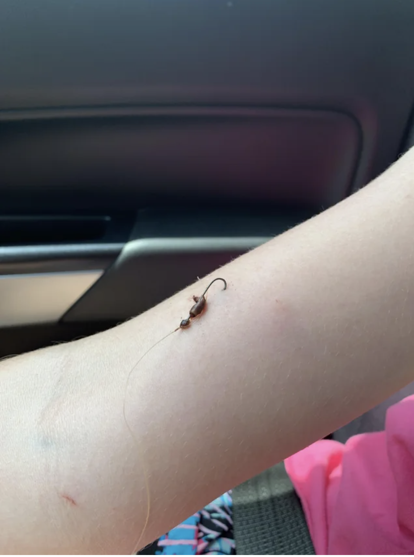 A fish hook in someone&#x27;s arm