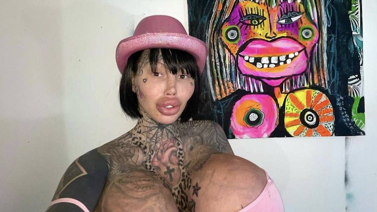 An Instagram model who crowned herself the “Uniboob Queen” after her 38J implant popped said she lost 20 pounds after breast reduction surgery.