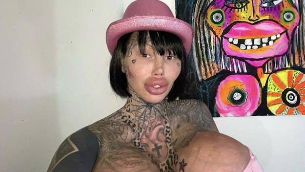 An Instagram model who crowned herself the “Uniboob Queen” after her 38J implant popped said she lost 20 pounds after breast reduction surgery.