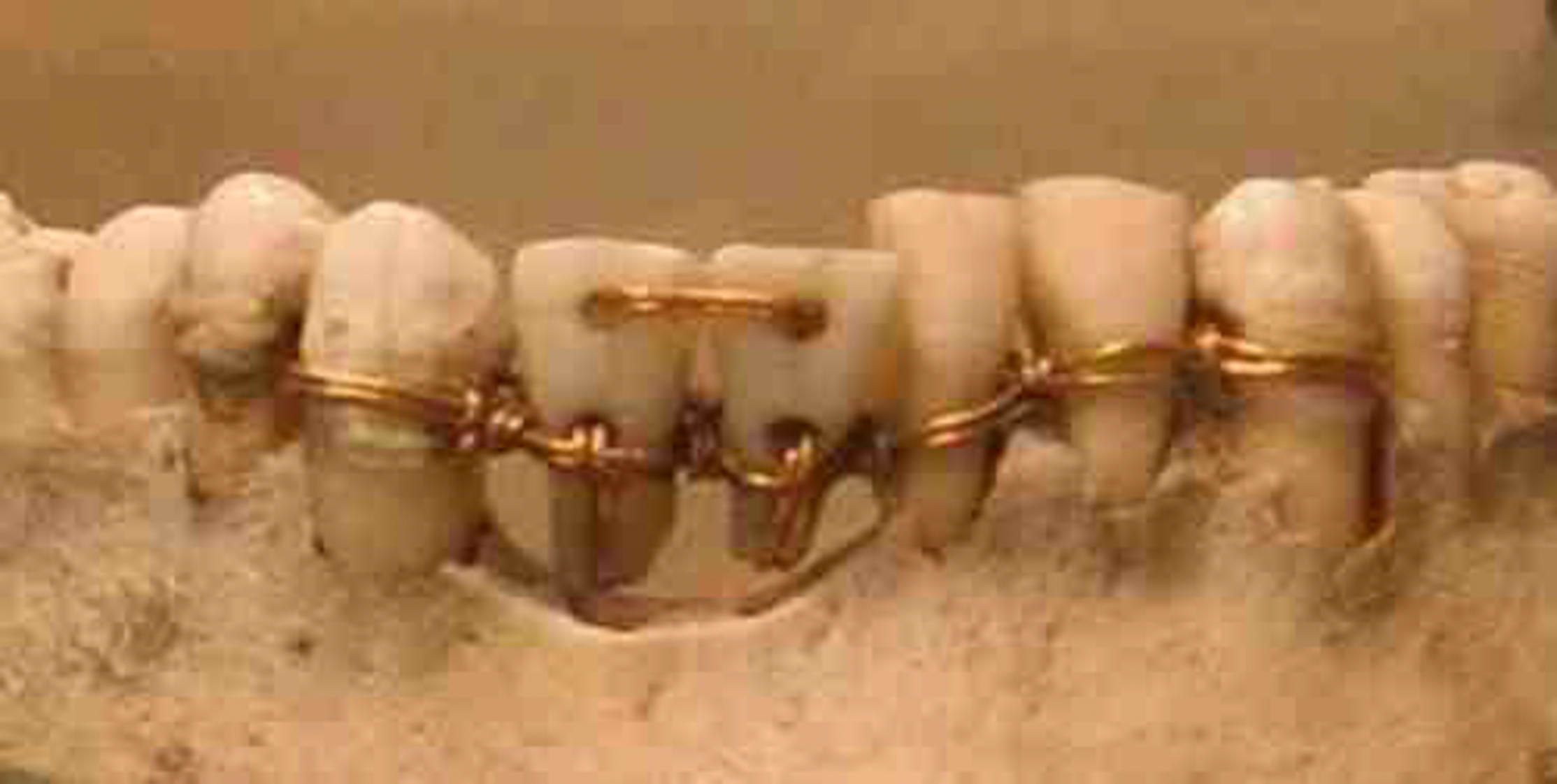 A row of bottom teeth with copper-looking wires on them