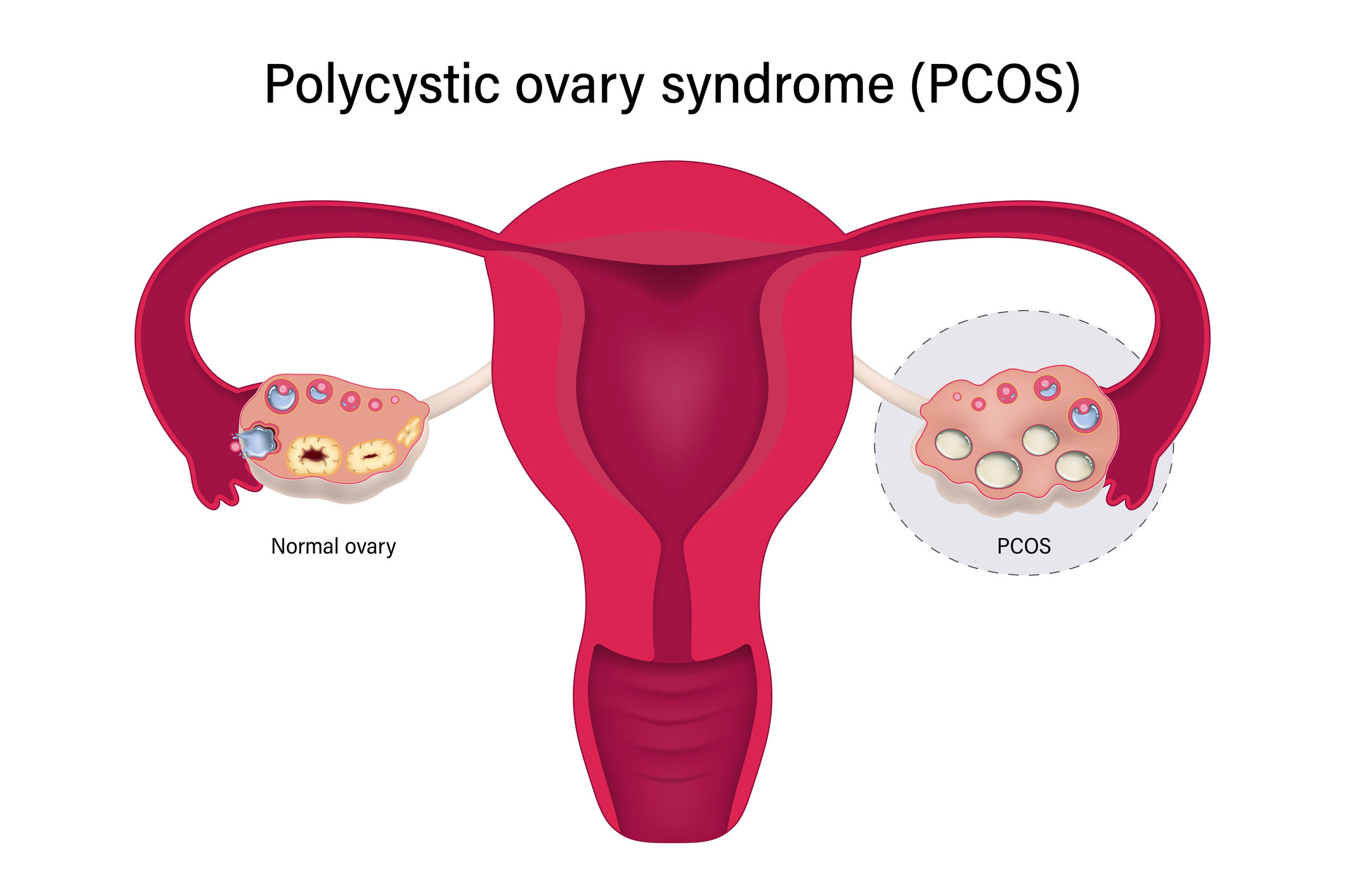 An illustration of a uterus with ovaries and cysts on ovaries demonstrating PCOS
