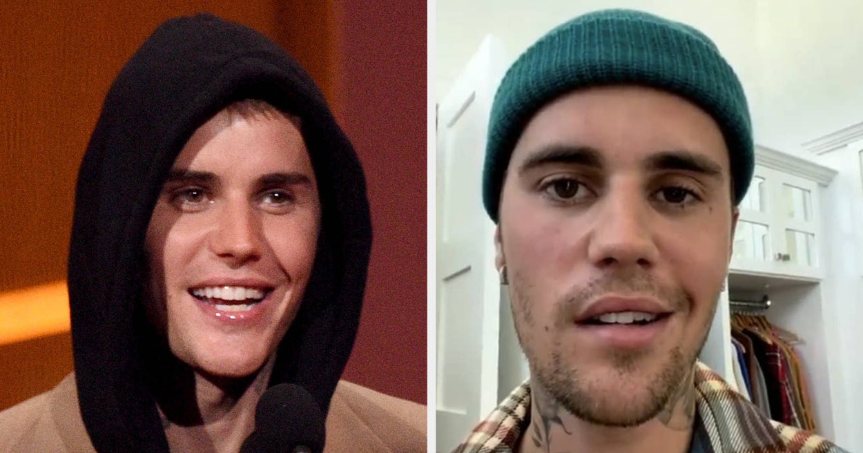 Justin Bieber Shared A Health Update With Fans By Posting A Video Of Himself Moving Both Sides Of His Face After He Suffered From Facial Paralysis Last Year