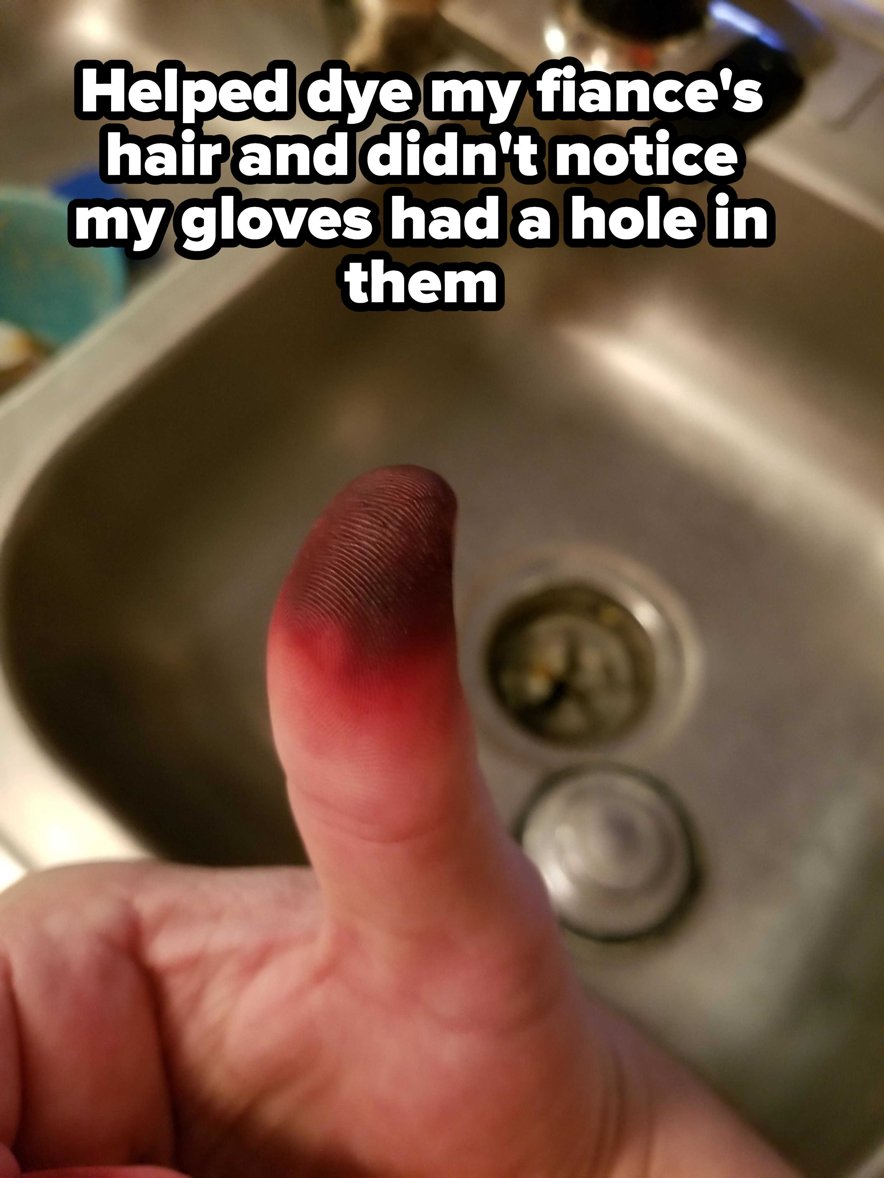 A burnt thumb