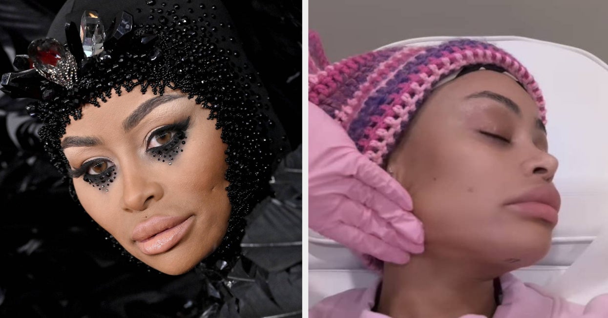 Blac Chyna Dissolved All Of Her Facial Fillers, And The Results Are Dramatic