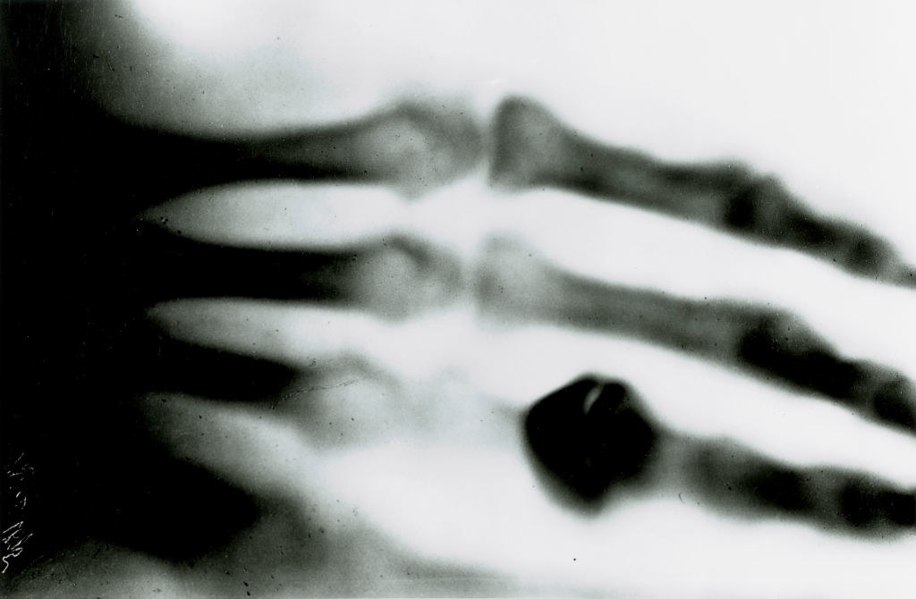 Blurry X-ray of a skeletal hand