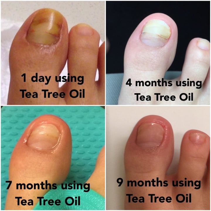 Reviewer showing progress of toenail healing using tea tree oil foot soak: 1 day, 4 months, 7 months, and 9 months