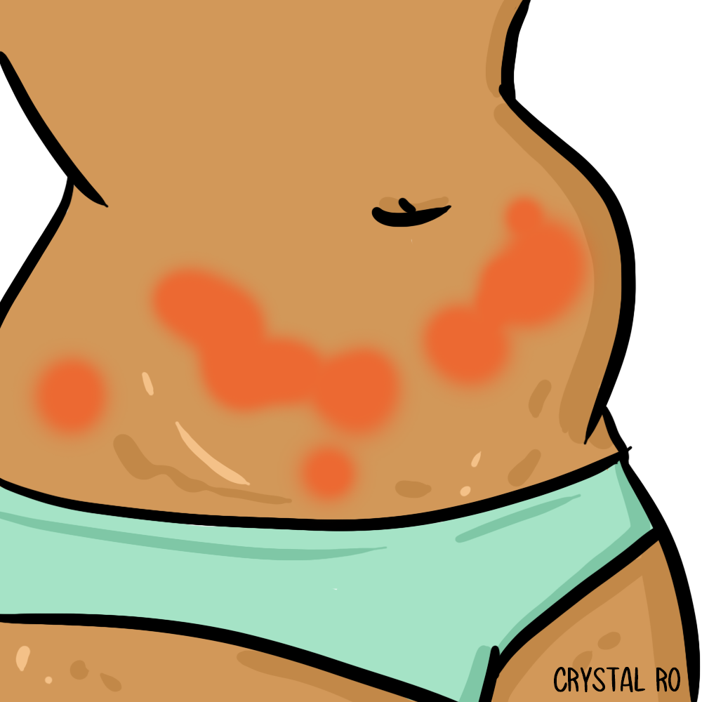 An endometriosis belly with bloating and burns
