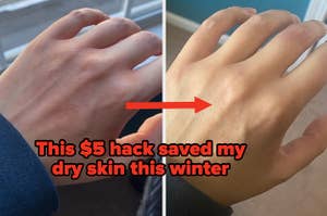Left: An irritated and inflamed hand Right: A less irritated hand with an arrow connecting the two images with the caption "This $5 hack saved my dry skin this winter"