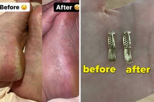 before and after foot peel and before and after of ring cleaned