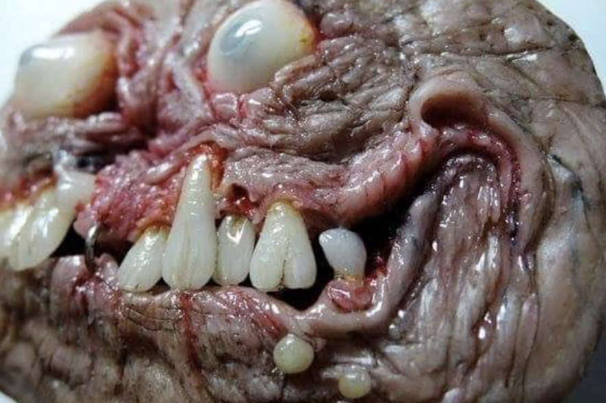 Close-up of a teratoma with eyes and many teeth