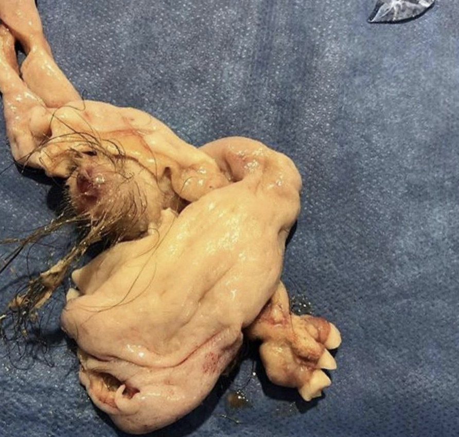 Close-up of a twisted teratoma with hair