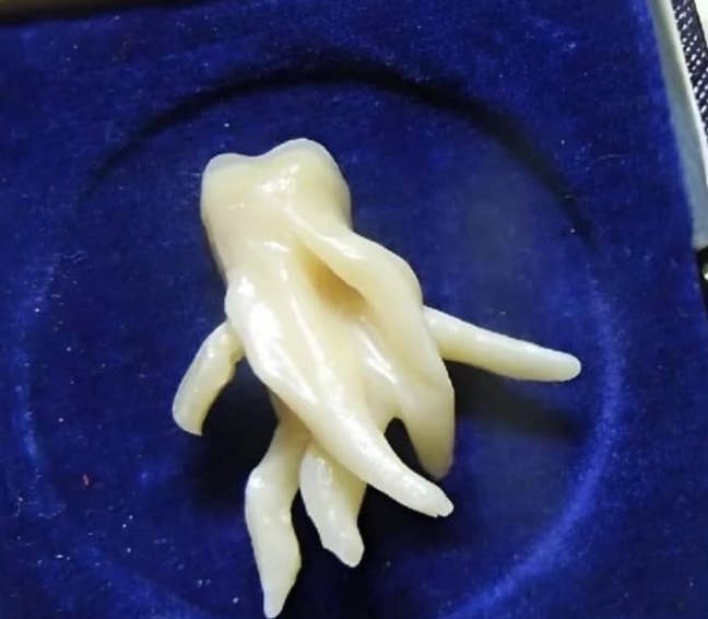 A wisdom tooth with twisted roots