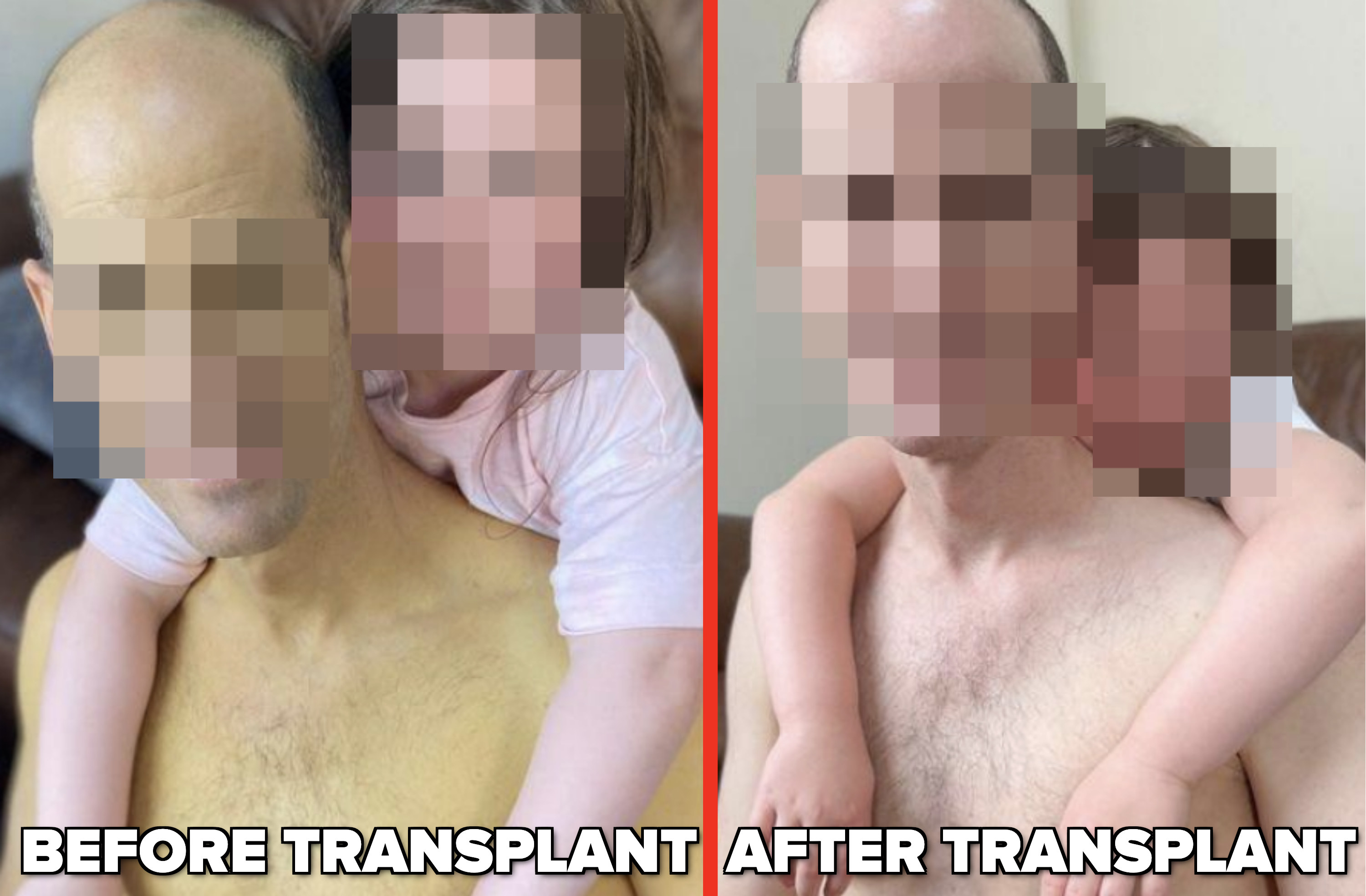 Before and after a liver transplant
