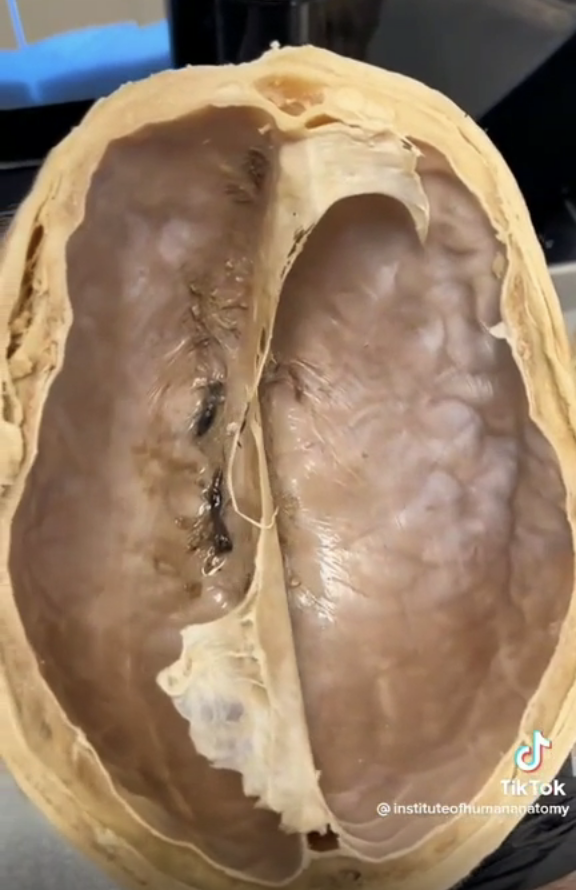 Close-up of inside the human skull showing the top of the brain