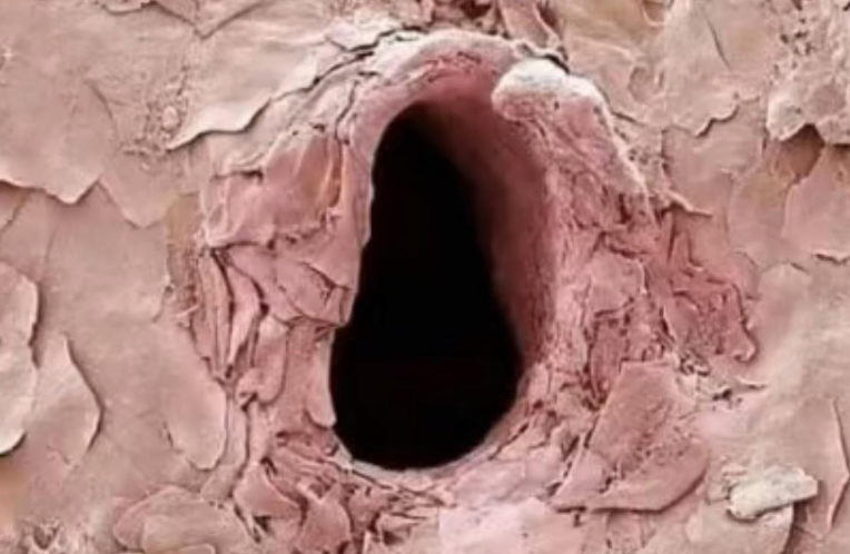 Closeup of a hole in the skin