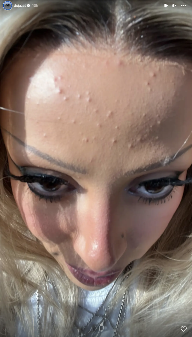 closeup of the acne on her forehead