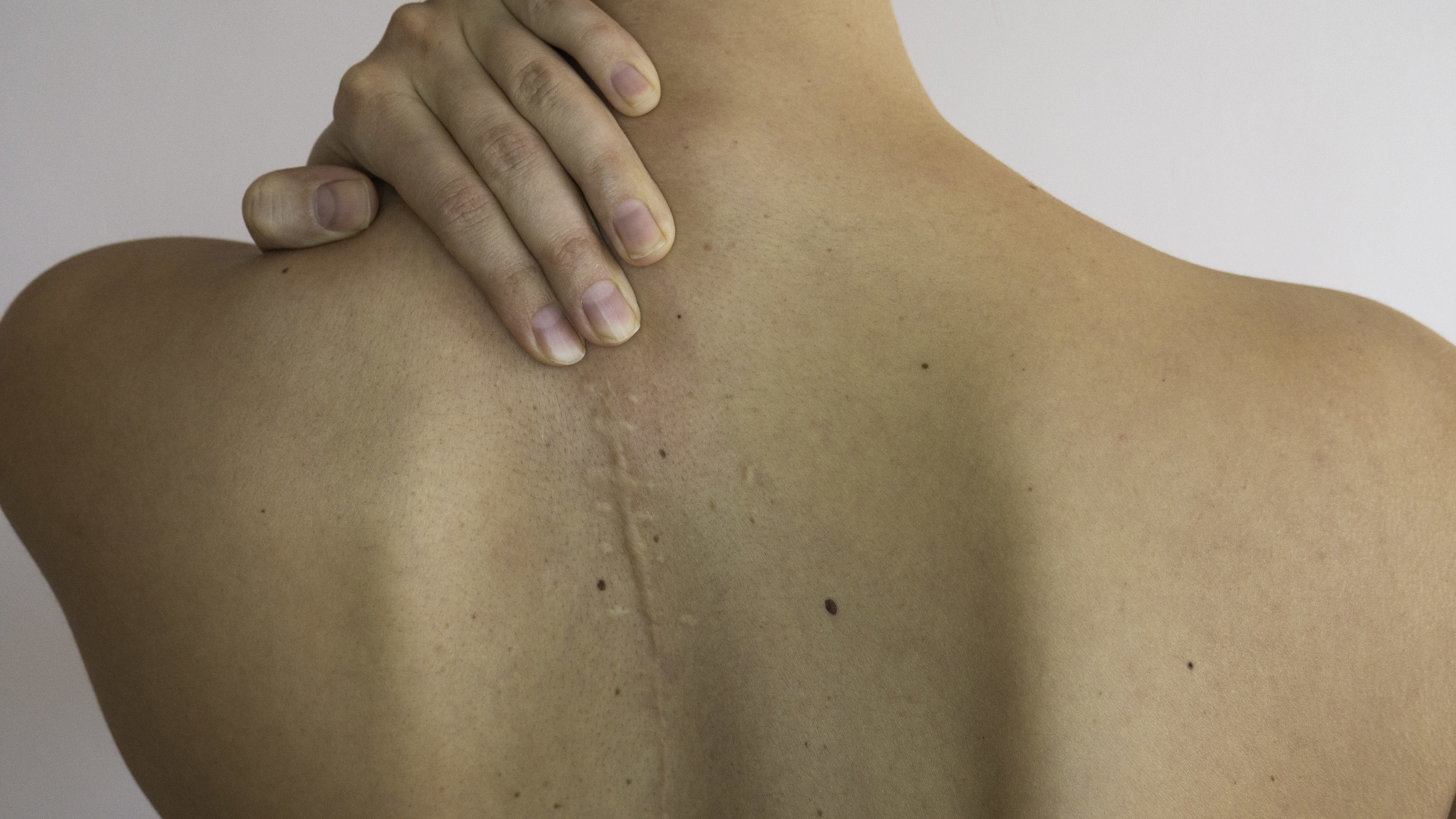 a scar on a woman&#x27;s back