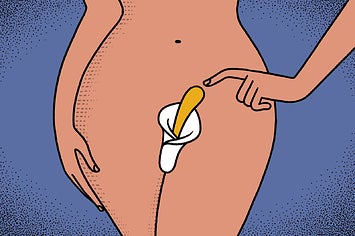 Clitoral Enlargement Surgery Is Growing