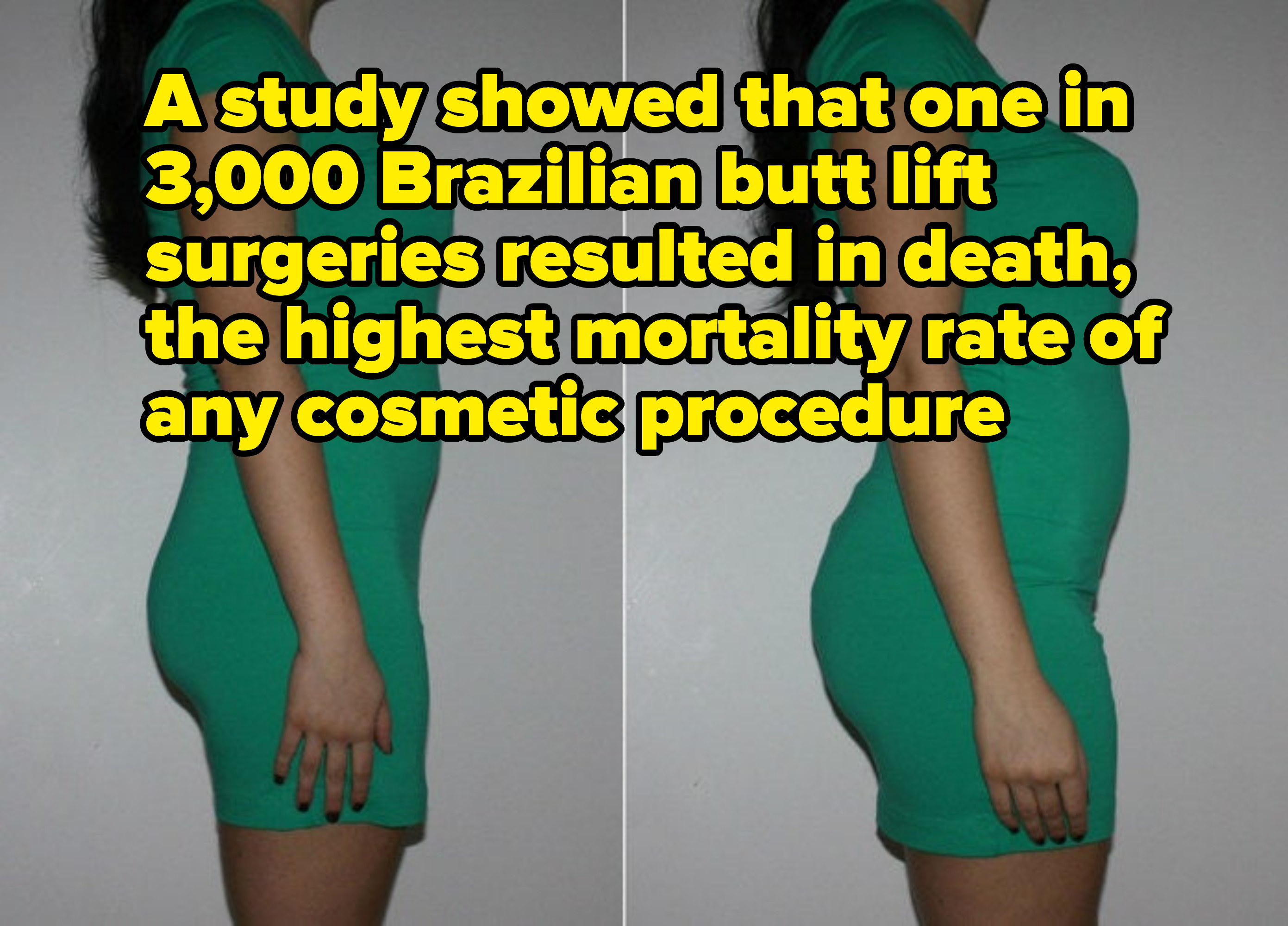 before and after photos with text reading, a study showed that 1 in 3000 brazillian butt lift surgeries resulted in death, the hight mortality rate of any cosmetic procedure