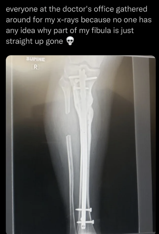 An X-ray showing a missing part of the person&#x27;s fibula