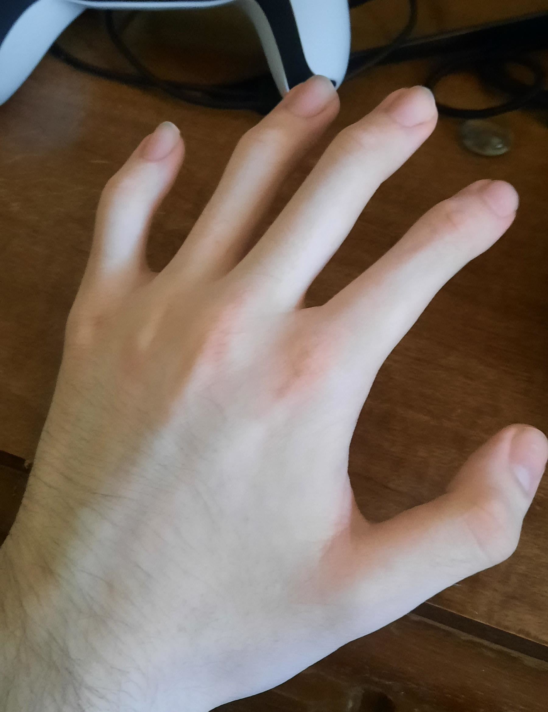 no middle knuckles on a hand