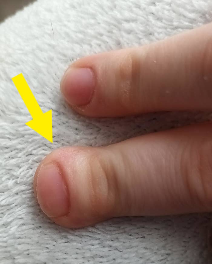 arrow pointing to the growth on the finger