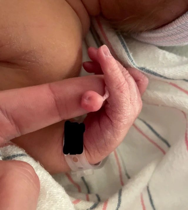 baby hand with an extra circular tissue attached