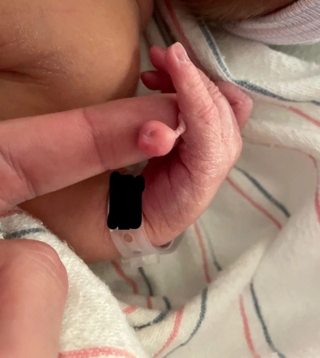 baby hand with an extra circular tissue attached